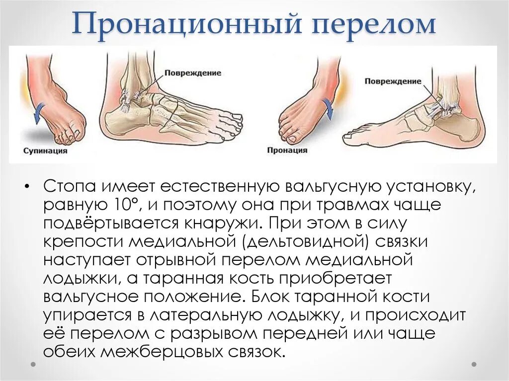 Сильные боли в голеностопном суставе. Ушибы травмы растяжение голеностопа. Ударила сбоку стопу болит сильно. Разрыв связок стопы сбоку. Механизм травмы при повреждениях голеностопного сустава.