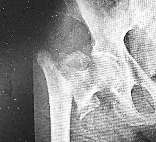 резекция головки бедренной кости