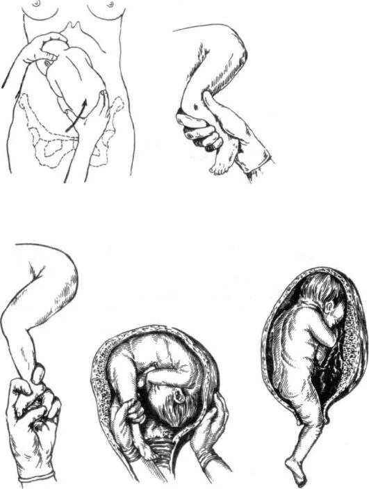 Положение плода в животе. Ягодичное предлежание плода поворот. Тазовое предлежание плода на 30 неделе беременности. 37 Неделя беременности предлежание плода. Ягодичное предлежание плода роды.
