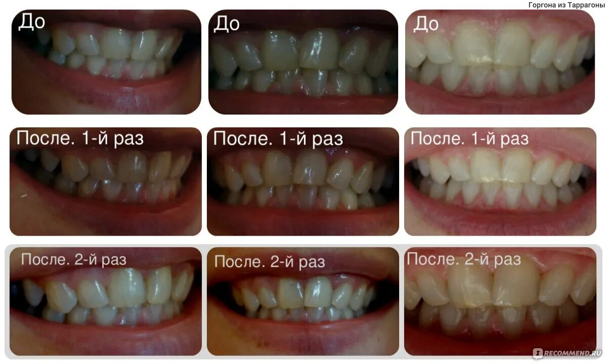 Отбеливание зубов Air Flow. Профессиональная чистка зубов до и после. Чистка зубов после лечения