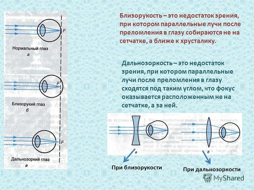 Оптическая схема глаза с близорукостью и дальнозоркостью. Оптическая система глаза при близорукости. Линзы и дефекты зрения. Дефекты зрения близорукость. Оптическая сила линзы оптические приборы