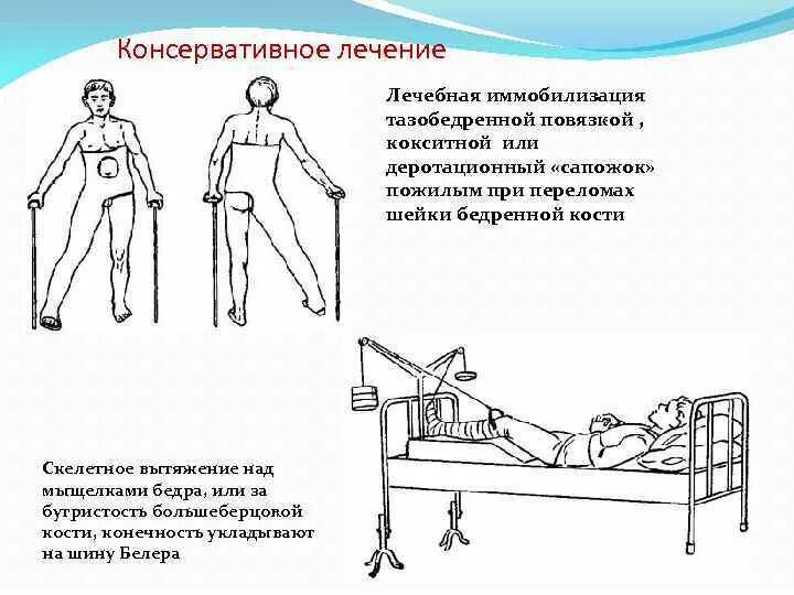 Сколько после операции шейки бедра. Перелом шейки бедренной кости иммобилизация. План реабилитации при переломе шейки бедра. Положение больного с переломом шейки бедра. Перелом шейки бедра положение пациента.