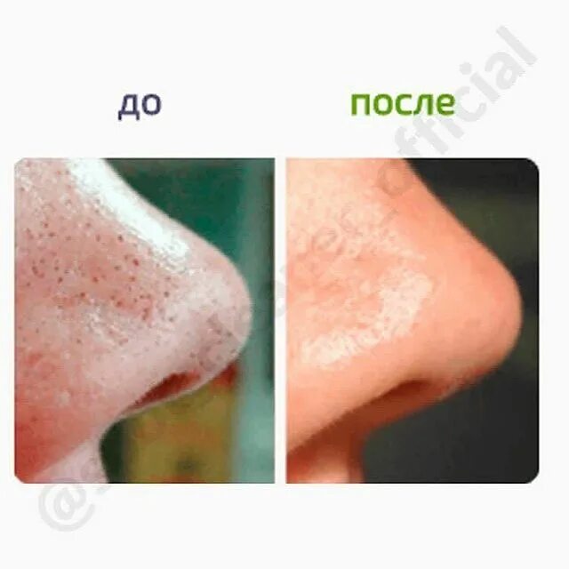 Избавиться от черных точек. Чистка лица. Убирание прыщей зубной пастой. Как сделать чистку носа. Как сделать чистку носа.