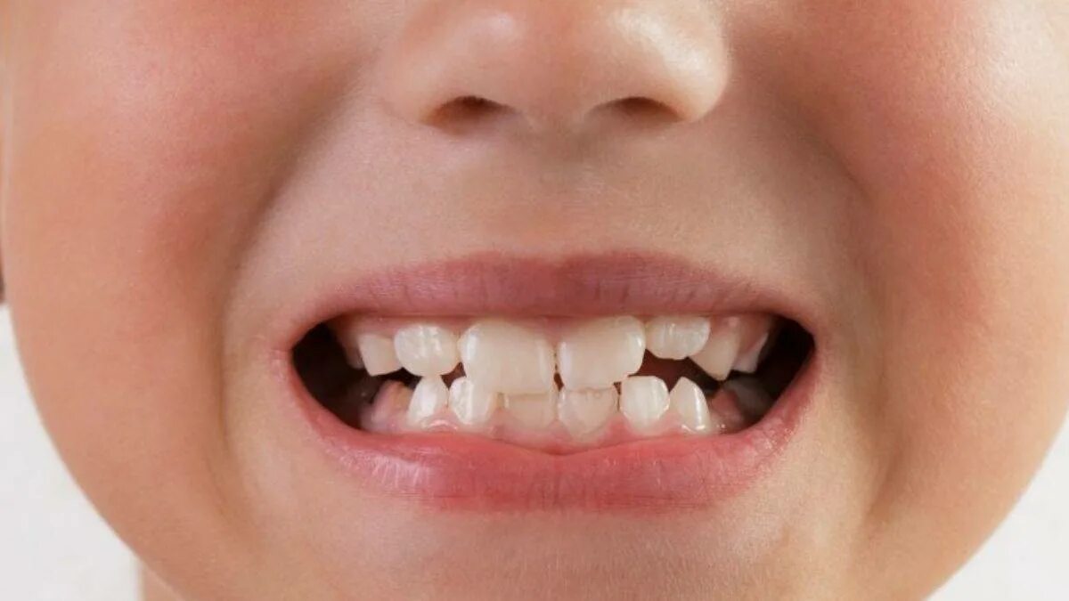Кривые коренные зубы у детей. Кривые коренные зубы у детей