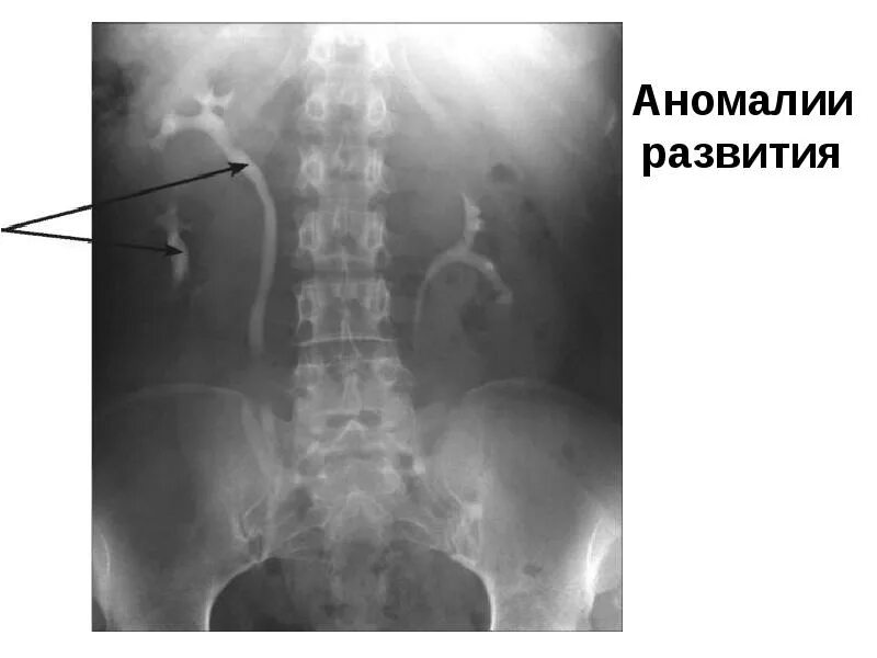 Удвоение мочеточника. Удвоение почки экскреторная урография. Удвоение ЧЛС экскреторная урография. Экскреторная урография гидронефроз. Удвоение мочеточника рентген.