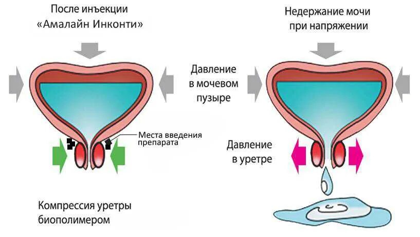 Непроизвольное Мочеиспускание У Женщин Во Время Секса