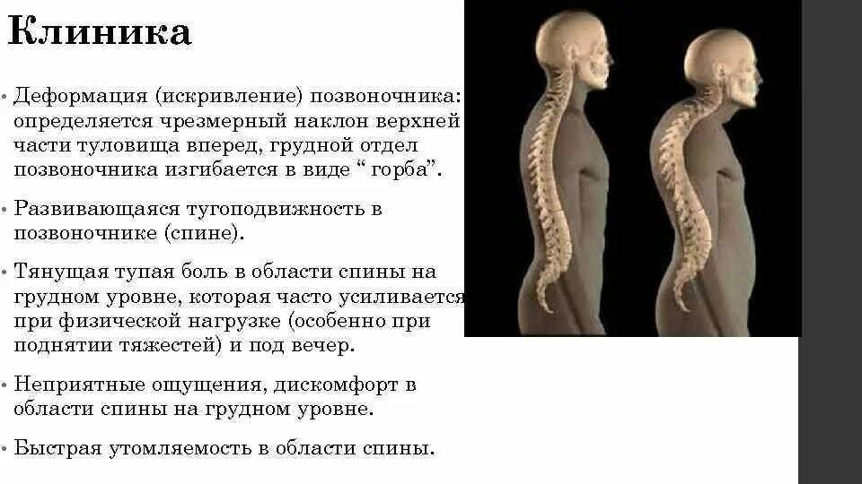 Болезнь шейермана мау что. Болезнь шейермана мау клиника. кифоз болезнь шейермана-мау. искривление позвоночника шерман мау. болезнь шейермана мау 3 степени.