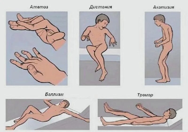 Дцп мышцы. Деформирующая мышечная дистония. Дистонический гиперкинез. Гиперкинетическая форма.