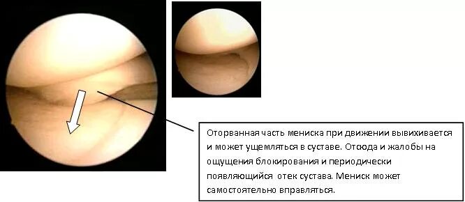 После эндопротезирования коленного сустава. Диагноз разрыв мениска. Разрыв мениска и крестообразной связки. Отрыв крестообразной связки колена. Операция пластика пкс коленного сустава.
