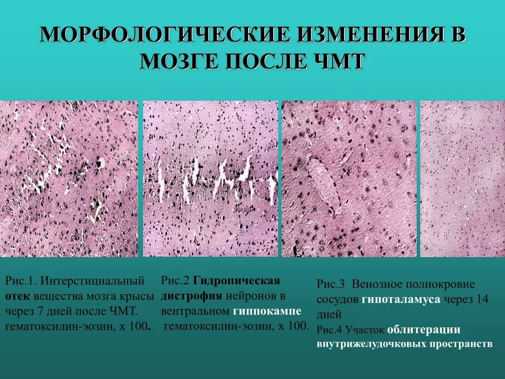 Дегенерация головного. Гидропическая дистрофия нефрона. Отек головного мозга гистология. Дистрофические изменения нейронов. Хорологические изменения.