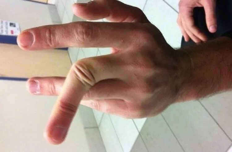 Как узнать что сломал палец. Кактпонять что сломал пальцы. Как узнать что сломал палец. Закрытый перелом пальца. Отличить перелом от ушиба.