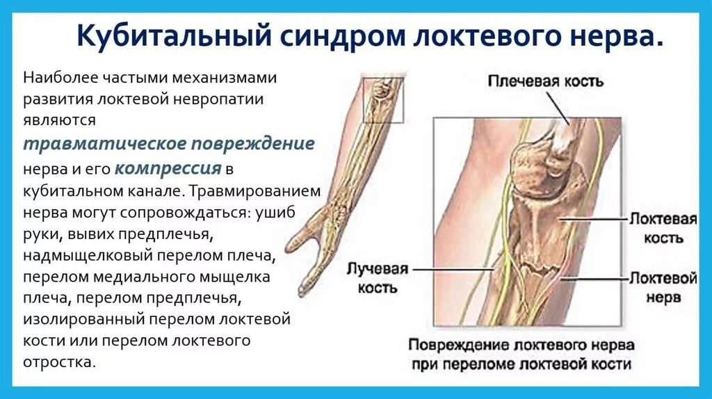 Туннельные нейропатии локтевой нерв. Невролиз локтевого нерва. Нейропатия лучевого и срединного нерва.