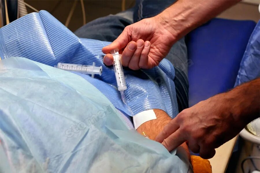 Общий наркоз внутривенно. Внутривенной седацией. наркоз внутривенная седация это. местная анестезия с внутривенной седацией. внутривенная медикаментозная седация.