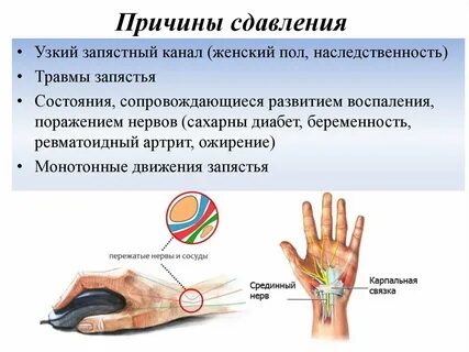 Синдром запястных каналов рук
