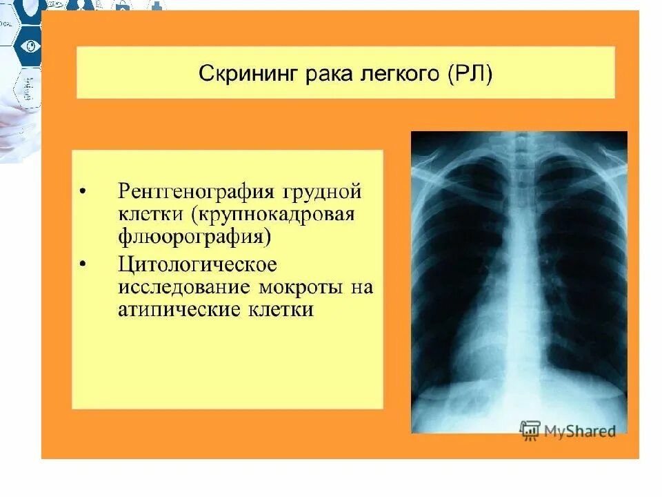 Скрининг рака легкого. Крупнокадровая флюорография грудной клетки. Скрининг легких. Флюорография злокачественных опухолей. Скрининг флюорография.