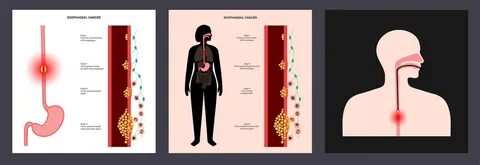 Esophageal cancer