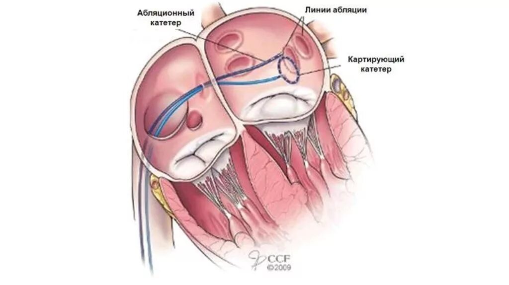 Радиочастотная катетерная абляция. Радиочастотная абляция сердца. Изоляция легочных вен