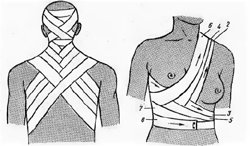 Повязка на молочные железы алгоритм. Десмургия повязка на молочную железу. Повязка Дезо на молочную железу. Десмургия повязки на грудную клетку. Наложение повязки на молочную железу.