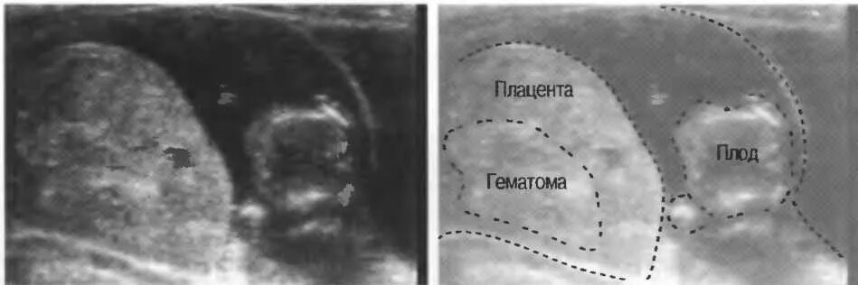 Гематома 6 недель. Ретроплацентарная гематома на УЗИ. Гематома на УЗИ при беременности. Субамниотическая отслойка плаценты.