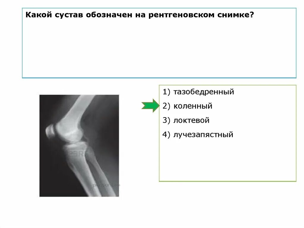 Какой сустав изображен. Какой сустав изображён на рентгеновском снимке. Какой сустав человека изображён на рентгеновском снимке. Какой сустав обозначен на рентгеновском снимке. Какой сустав изображён на рисунке.