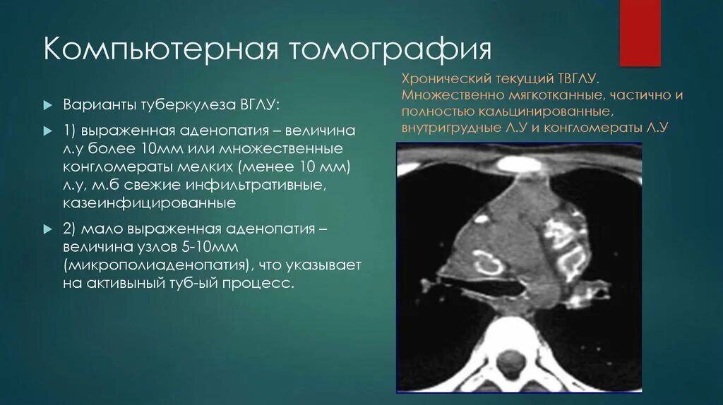 Аденопатия. Туберкулез внутригрудных лимфатических узлов кт. Компьютерная томография туберкулеза легких. Кт при туберкулезе легких.