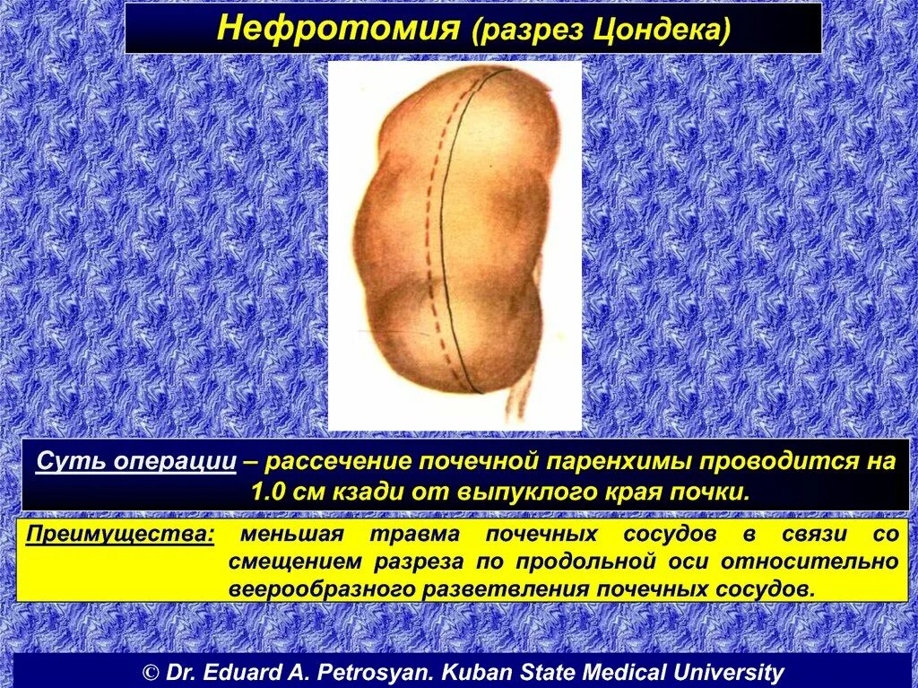 Нефротомия. Нефротомия. Нефротомия. Нефротомия и нефростомия что это. Нефротомия, пиелотомия.