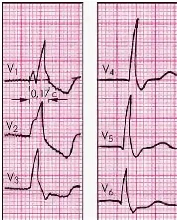 Нарастание зубца r. Нарастание зубца r в v1-v3. Раздвоенный зубец r на ЭКГ. Расщепление зубца r на ЭКГ. Двухфазный зубец r.