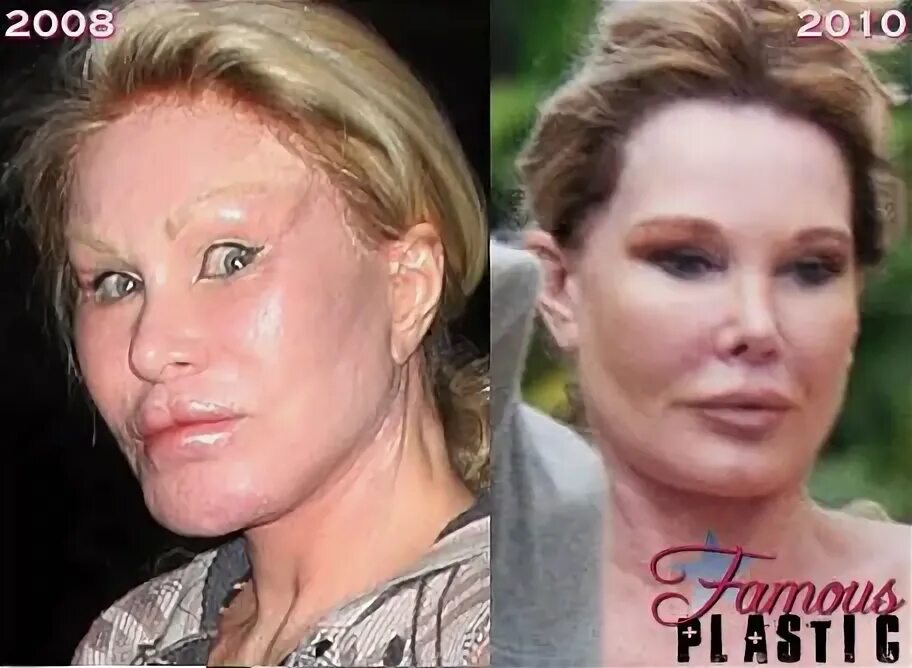 Celebridades que fizeram plásticas extremas Celebridades bonitas, Celebridades, 