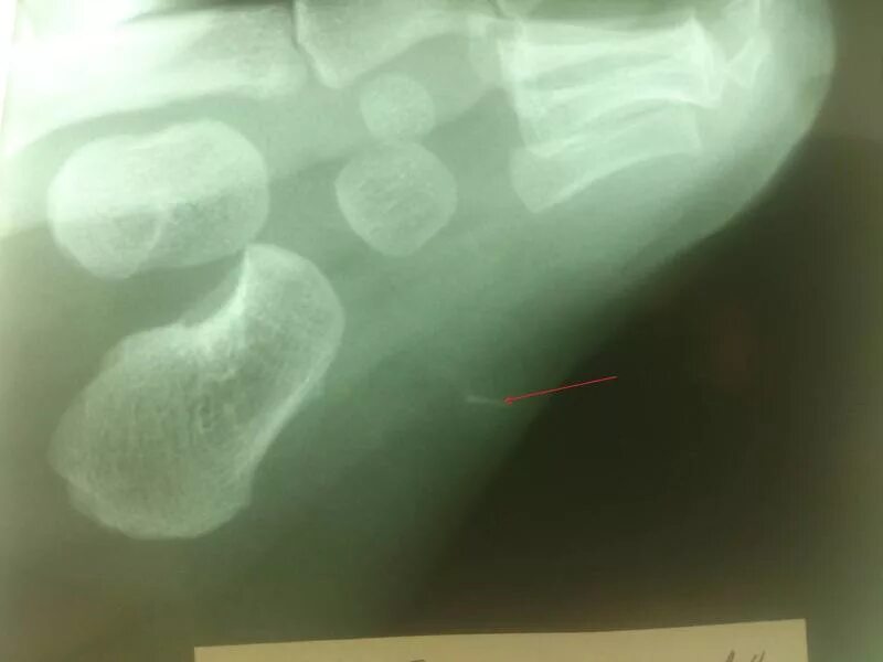 Инородное тело рентген стопа. Может ли швейная игла дойти до сердца. Может ли иголка дойти до сердца. Симптомы попадания иголки в тело. Миллениум убираю иголкой.