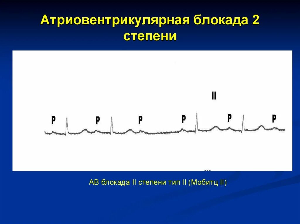 Атриовентрикулярная блокада 2. Атриовентрикулярная блокада степени. Атриовентрикулярная блокада 2 степени. Атриовентрикулярная блокада 2 степени Мобитц 1. АВ блокада 2 степени 2 типа.