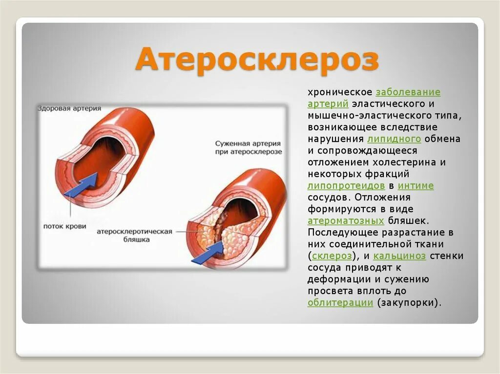 Атеросклероз (закупорка кровеносных сосудов). Атеросклероз венечных артерий. Осложнения атеросклероза венечных артерий. Профилактика атеросклероза коронарных артерий.