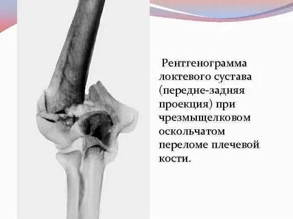 Чрезмыщелковый плечевой кости