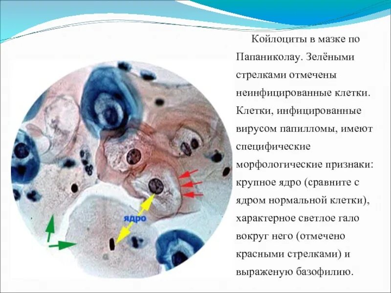 Атипия ядер клеток