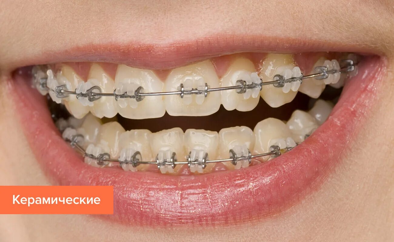 Брекеты топить. Брекеты экспириенс. Девушка с брекетами. Брекеты старые металлические. Перекрестный прикус брекеты.