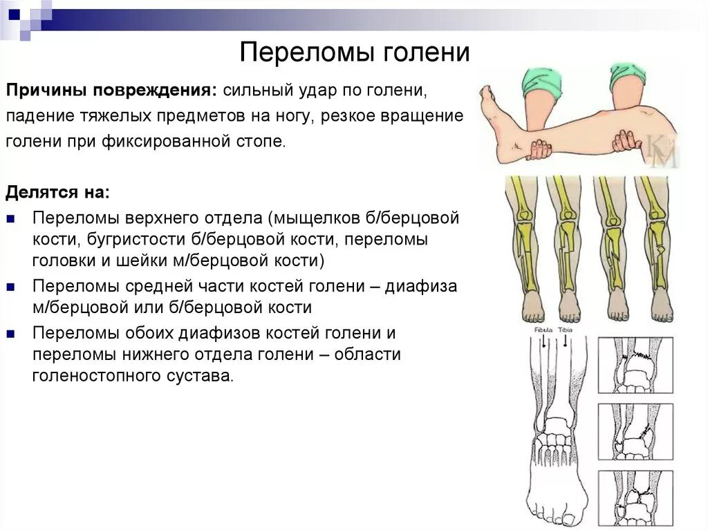 Степени открытого перелома. Переломы костей костей голени классификация. Классификация переломов костей голени. Перелом нижней трети малоберцовой кости голени. Каковы клинические проявления при переломе костей конечностей.