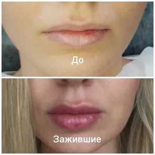 Сколько заживают губы после