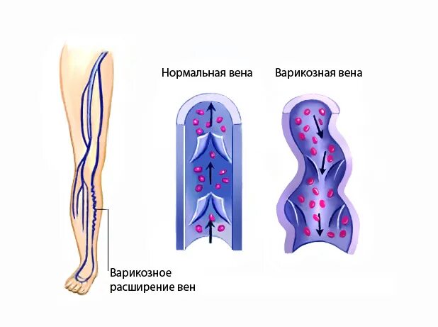 Венозный застой крови