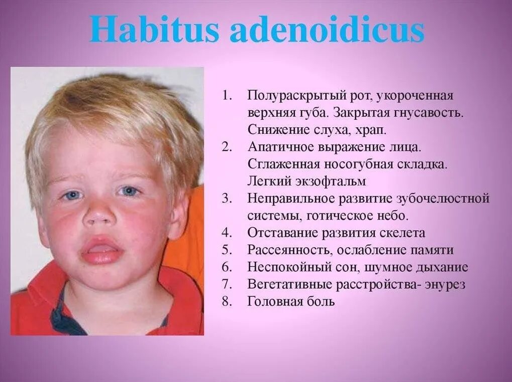 Что делать при аденоидах. Аденоидный Тип лица у детей. Аденоиды у детей симптомы.