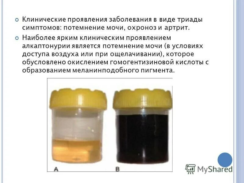 Какой цвет мочи при гепатите. Какой цвет мочи при гепатите. Какой цвет мочи при гепатите. Темная моча билирубин. Цвет кала и мочи при гепатите.