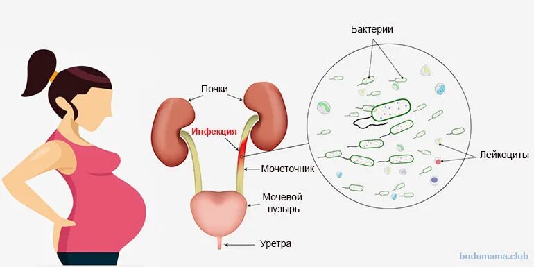 3 триместр цистит. Инфекция мочевых путей при беременности. Инфекции мочевыводящих путей у беременных. Инфекция мочеполовых путей при беременности. Почки беременной женщины.