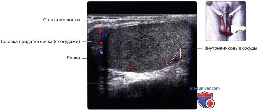 Болит яичко у мужчины. Нормы УЗИ мошонки нормы. Ультразвуковое исследование органов мошонки (яички, придатки). УЗИ органов мошонки + допплерография.