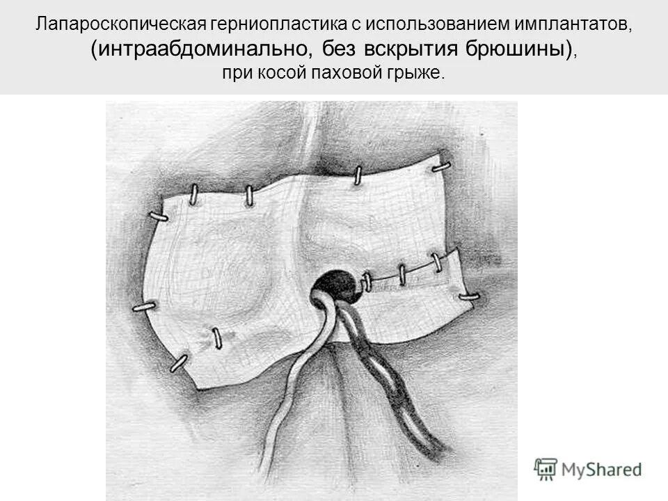 Паховая грыжа сколько больничный. Лапароскопическая хирургия грыжи паховой. Ход операции лапароскопическая герниопластика пупочной грыжи. Лапароскопическая герниопластика при паховой грыже.