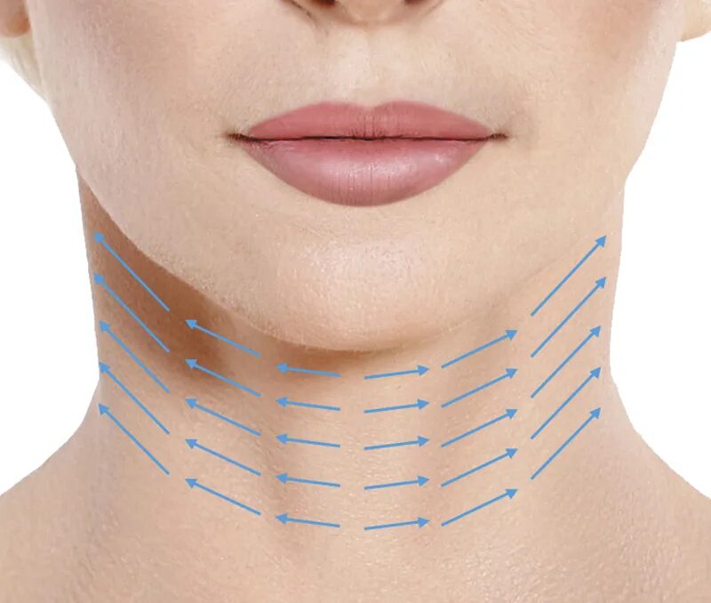 подтяжка шеи нитями аптос. нитевой лифтинг шеи. тредлифтинг 3d мезонитями. нитевой лифтинг aptos. нитевой лифтинг шеи.
