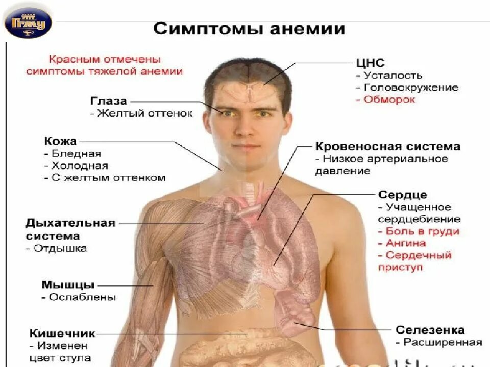 Как лечить анемию
