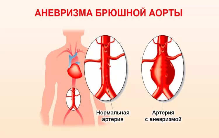 Псевдоаневризма брюшной аорты. 171.4 Аневризма брюшной аорты. Веретеновидная аневризма брюшной аорты. Аневризма абдоминального отдела аорты. Аневризма сердца что это такое симптомы