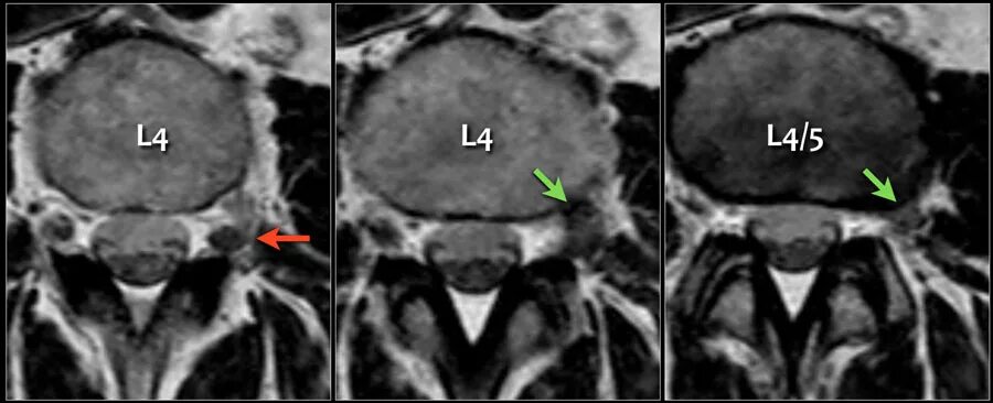 Грыжа мозговых оболочек освобождение нерва. Задняя парамедианная грыжа l4-l5. Экстрафораминальная грыжа диска l5-s1. Парамедианная грыжа мрт. Левосторонняя фораминальная грыжа l4 l5.
