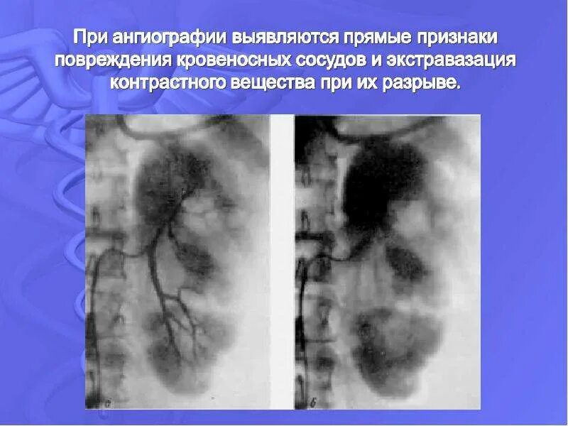 Что такое экстравазация. Экстравазация контрастного вещества. экстравазация контраста. экстравазация контрастного вещества при кт. экстравазация контрастного вещества при ангиографии.