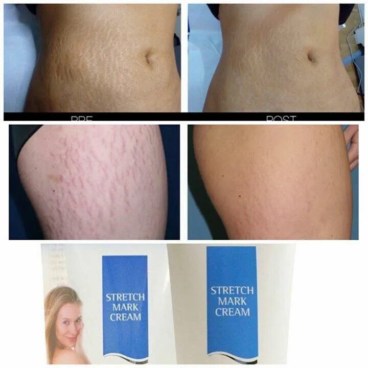 Stretch mark cream. Stretch Marks Cream от растяжек. Stretch Marks крем от растяжек Dr.James. Reviderm stretch Mark Cream.