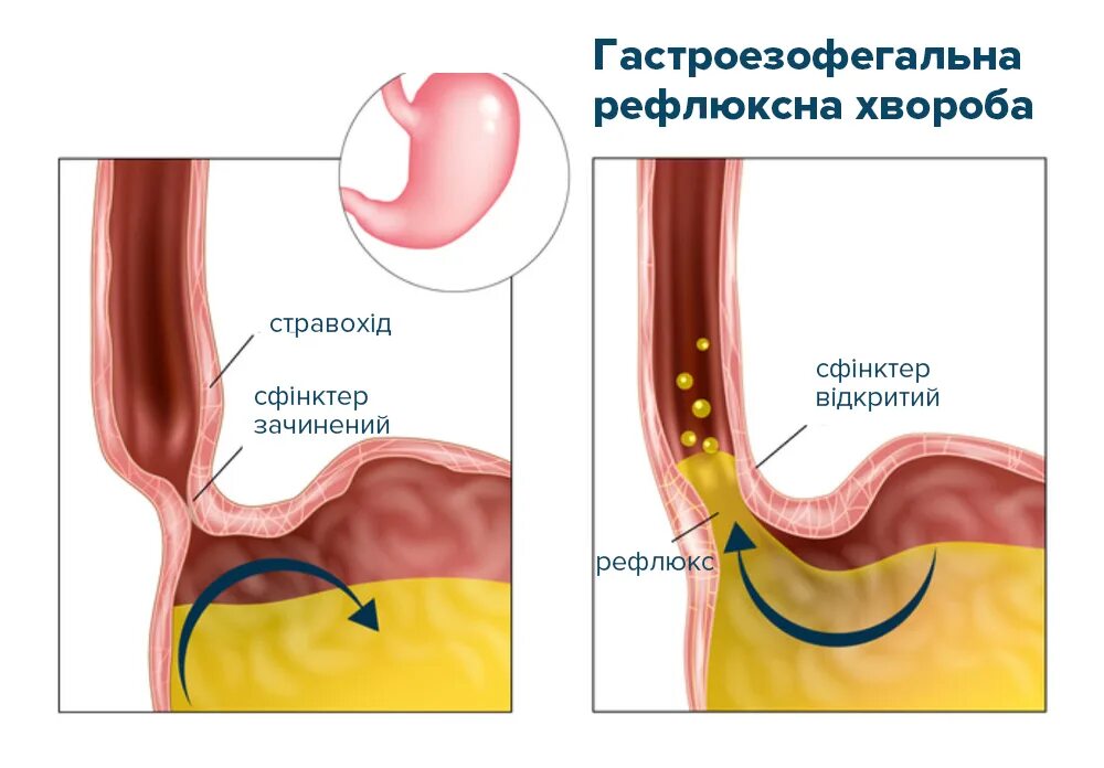 Рефлюкс у подростков. Гастроэзофагеальная рефлюксная болезнь. желудочно-пищеводный рефлюкс.