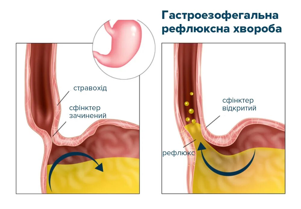 Жгучие боли в пищеводе. Гастроэзофагеальная рефлюкс-болезнь. Гастроэзофагеальный рефлюкс Гастроэзофагеальная болезнь. Гастроэзофагеальный пролапс желудка что это.